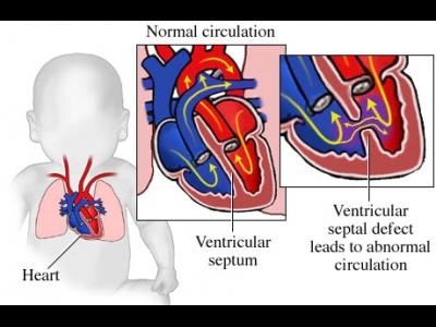 Cateterismul cardiac